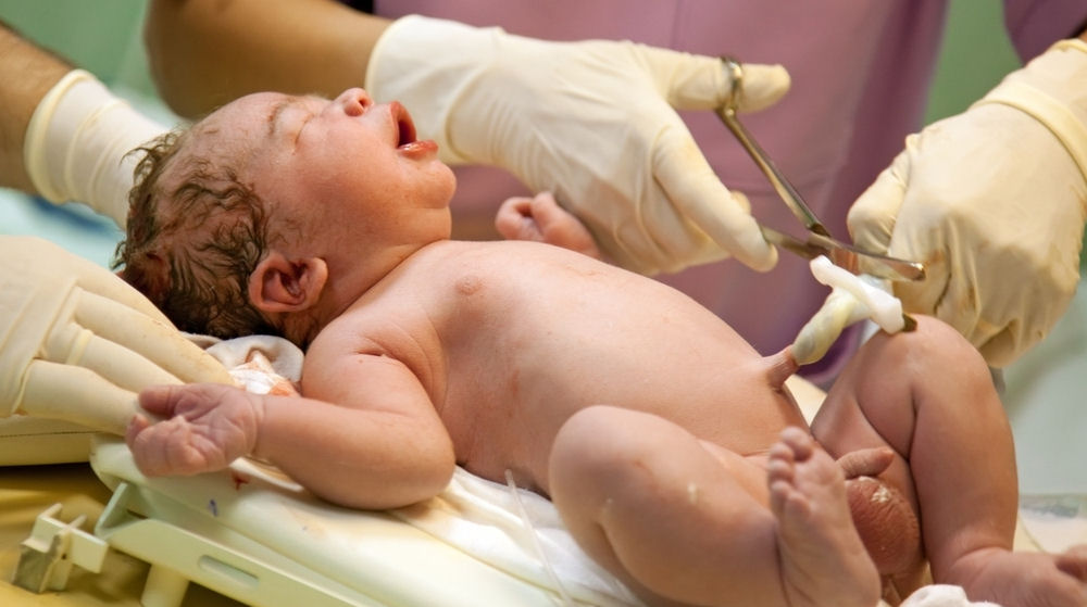 More Preterm Babies Survived After Delayed Cord Clamping