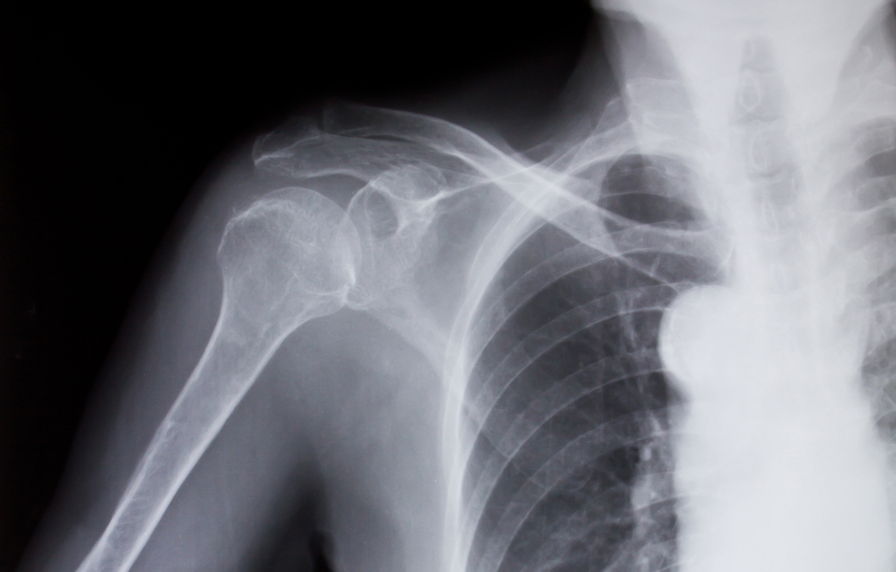 shoulder x-ray