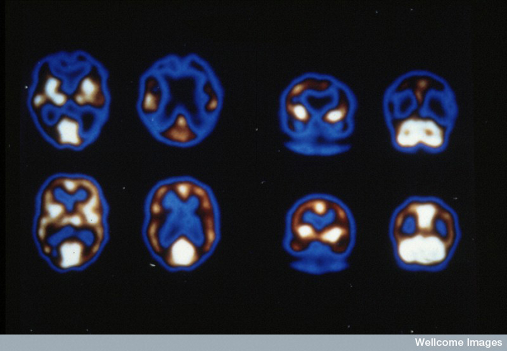 N0016670 Alzheimer's dementia and normal brain blood flow