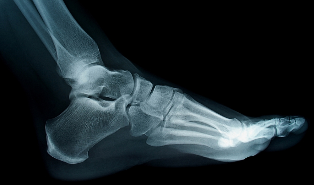 A common issue with sprained ankles - Students 4 Best Evidence