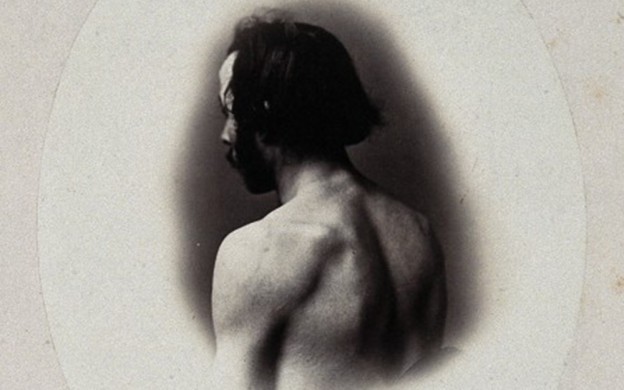 V0029478 A man's head and left shoulder, unclothed and viewed from be Credit: Wellcome Library, London. Wellcome Images images@wellcome.ac.uk http://wellcomeimages.org A man's head and left shoulder, unclothed and viewed from behind. Photograph by L. Haase after H.W. Berend, 1865. 1856 By: Heimann Wolff Berend and L. Haase & Co Kˆnigl Hofphotographen (Berlin).Published: - Copyrighted work available under Creative Commons Attribution only licence CC BY 2.0 http://creativecommons.org/licenses/by/2.0/