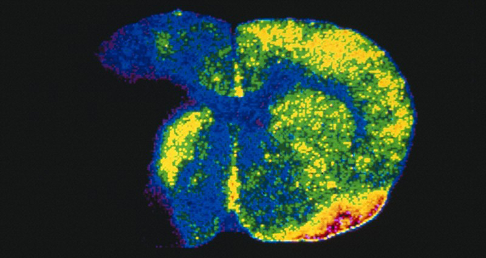 Wellcome Images: Ischaemia, blood flow through brain