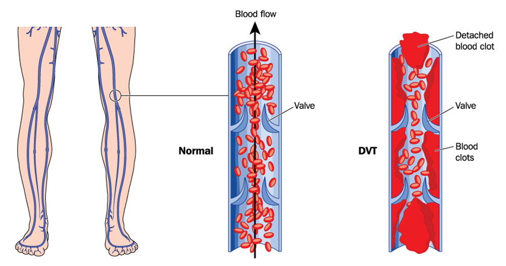 DVT