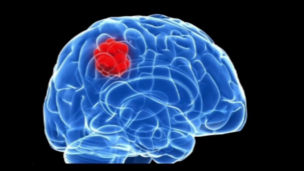 WHO's New Classification of Central Nervous System (CNS) Tumours