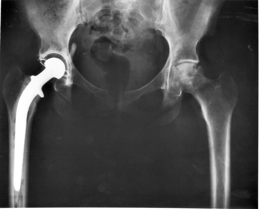  Hip Replacement - Physical Therapy