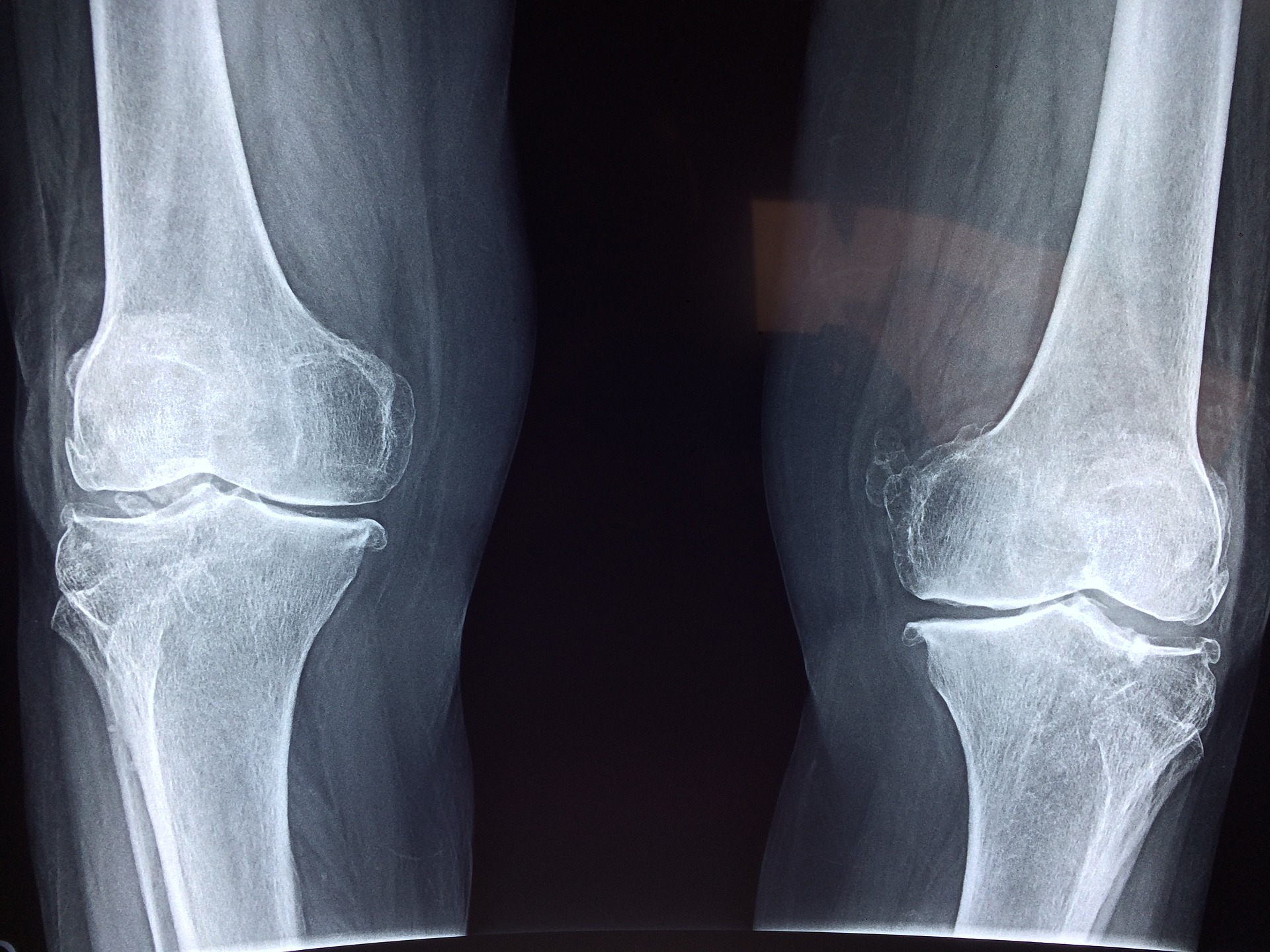 Xray of knees with osteoarthritis