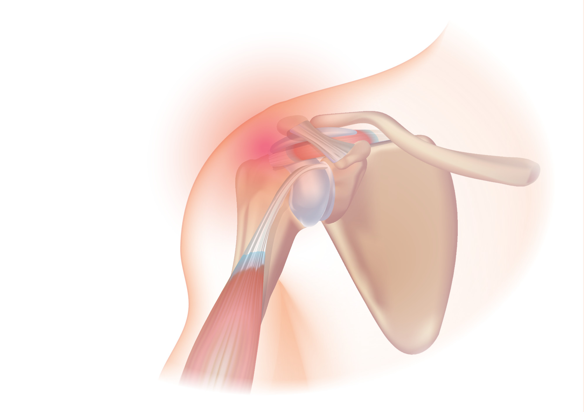 Rotator Cuff Repair - Back in Action