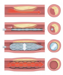 Examples of stenting